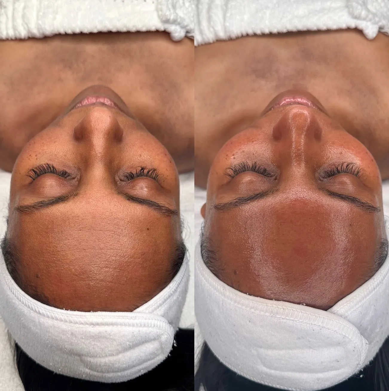 What’s the Best Facial Treatment for Your Skin?